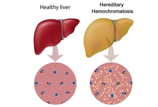 Hereditary Hemochromatosis, shutterstock 